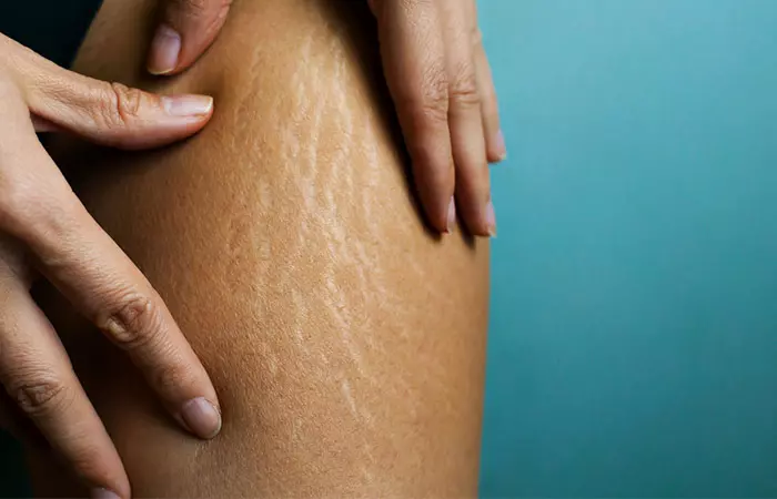 Striae albae stretch marks