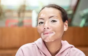 Woman with vitiligo may have ulcerative colitis