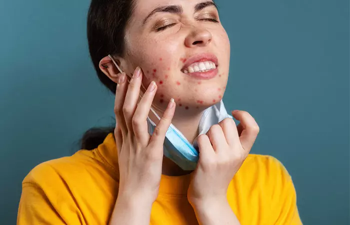 Woman suffering with fungal acne