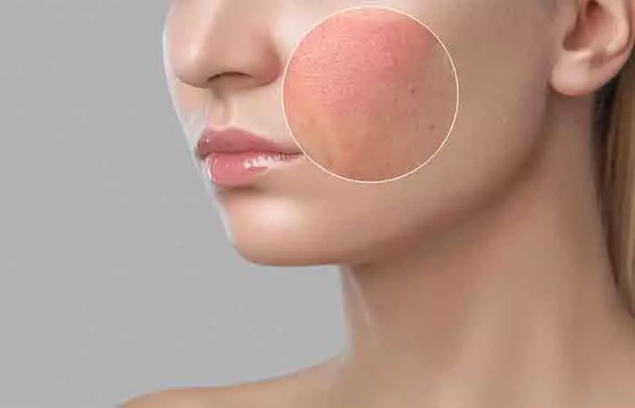 Skin redness after a microneedling procedure