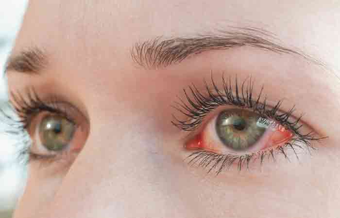 Red eyes due to makeup irritation