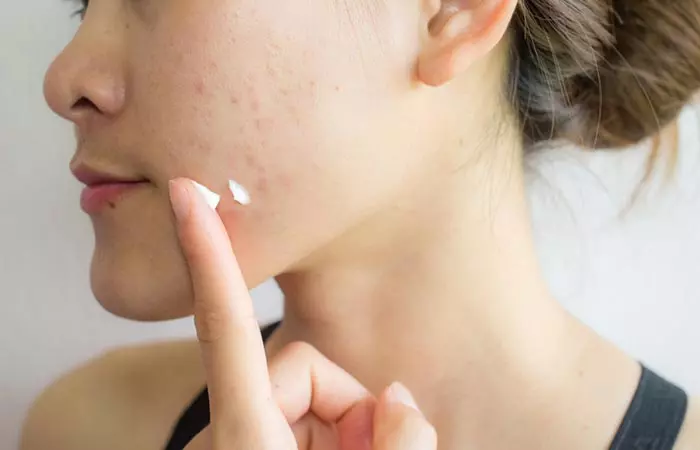 A woman applying Calamine lotion on acne