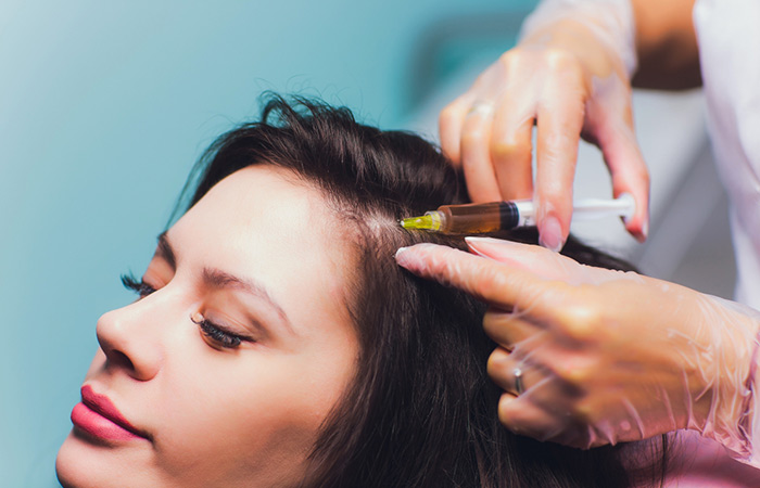 PRP therapy as a treatment for PCOS hair loss