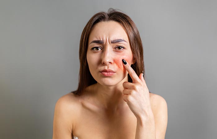 Woman with skin redness due to the side effects of dermalinfusion