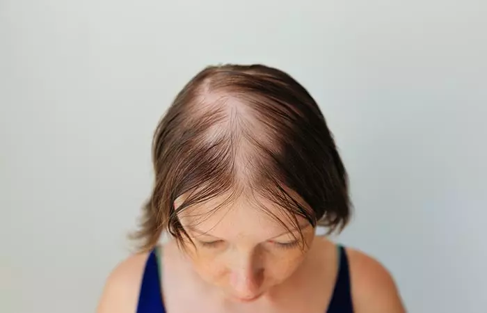 Woman experiencing hair loss due to metformin