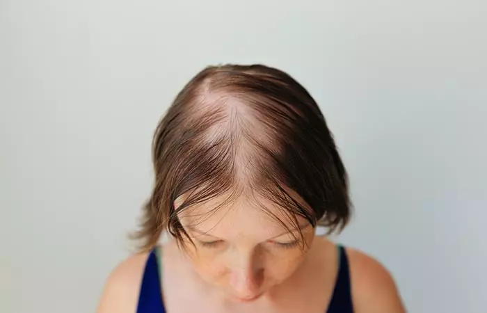 Metformin And Hair Loss  Is There A Connection  - 10