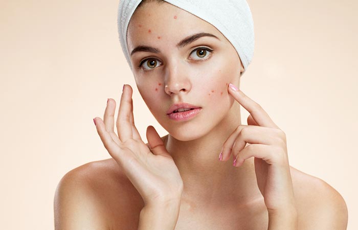 Woman with acne may benefit from dermalinfusion 