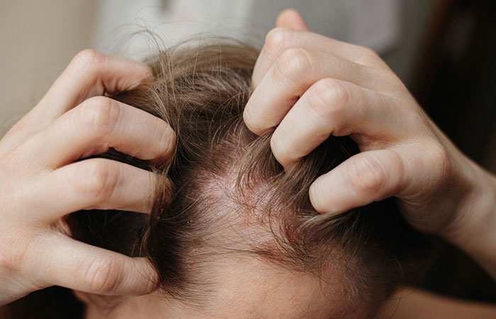 Woman experiencing red and irritated scalp after radiation therapy
