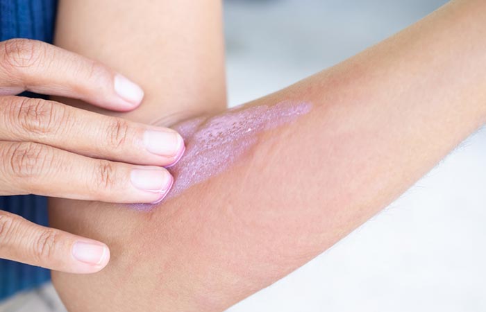Calamine lotion relieves itching and irritation