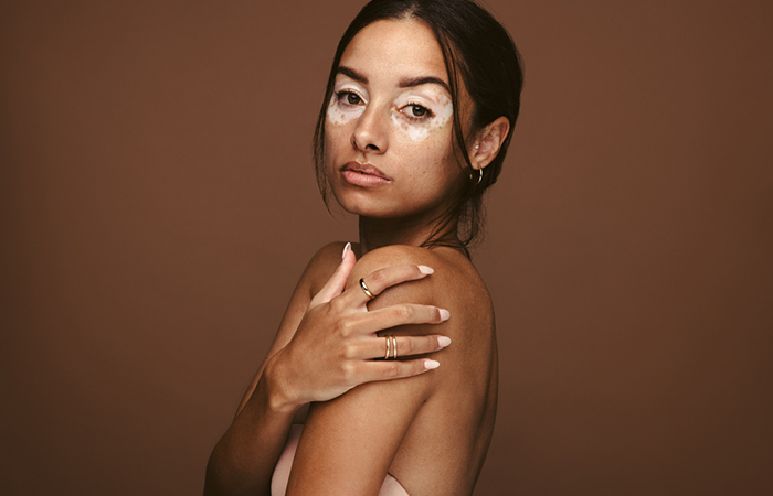 CoQ10 may worsen vitiligo