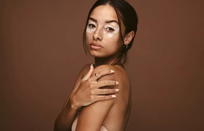 CoQ10 may worsen vitiligo