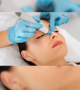 All You Need to Know About Laser Treatment For Acne Scars 