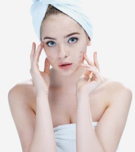 Can You Use Zinc To Treat Acne Spots and Scars?