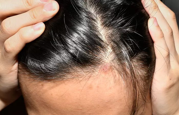 Woman with scalp infection may benefit from monistat