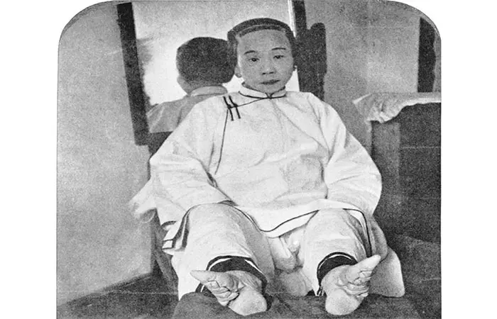 Foot Binding To Achieve "Lotus-Like" Feet
