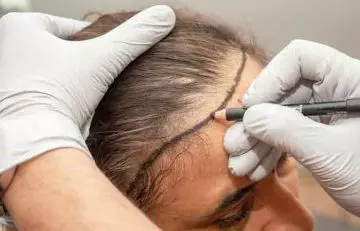 Closeup of a hair transplant specialist making markings on a woman's hair line for the desired transplant process