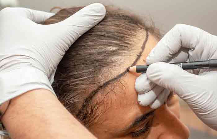 Closeup of a hair transplant specialist making markings on a woman's hair line for the desired transplant process