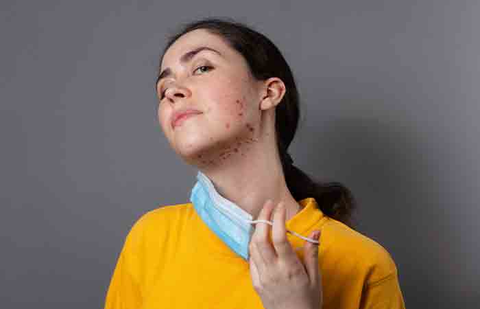 Woman with skin irritation due to tea tree oil
