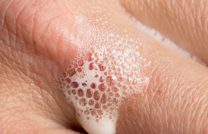 Hydrogen peroxide on an open finger wound