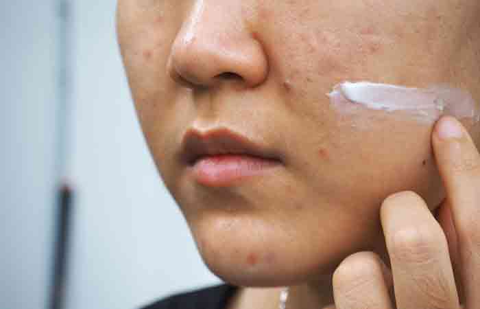 Woman applying Vitamin D cream to manage acne.