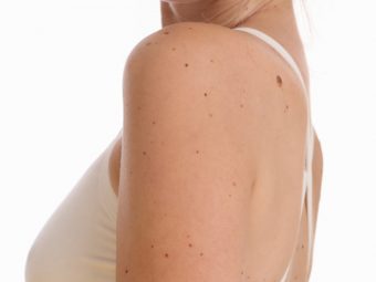 Essential Oils For Skin Tags: Do They Work?