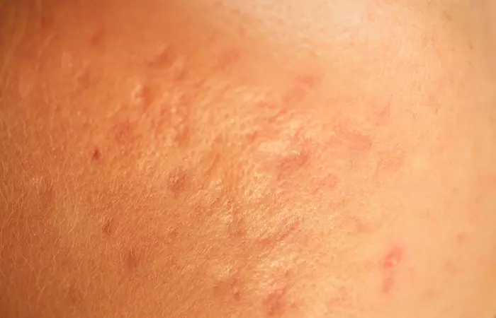 How to fade chickenpox scars