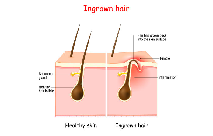 Ingrown hair scars