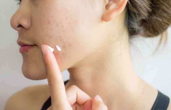 Woman applying sodium PCA on acne