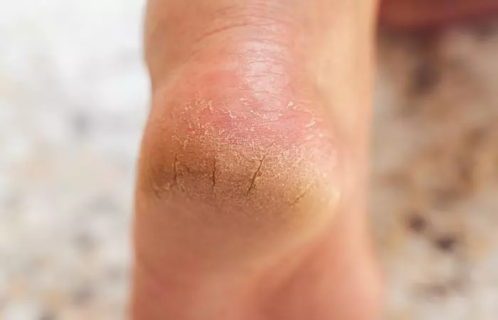 It Helps Heal Cracked Heels