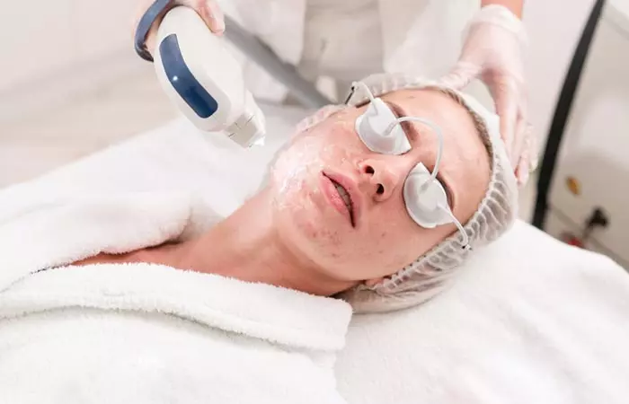 Woman undergoing laser treatment for nodular acne