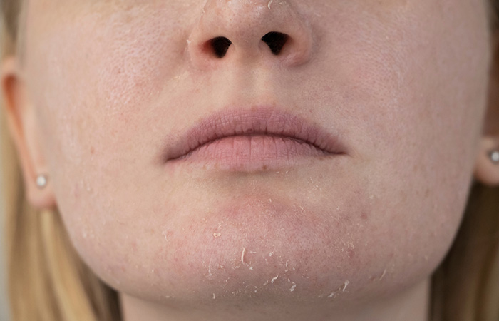 Woman facing dryness after using alcohol denat for skin