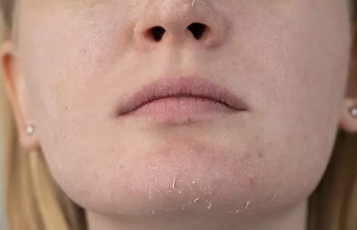 Woman facing dryness after using alcohol denat for skin