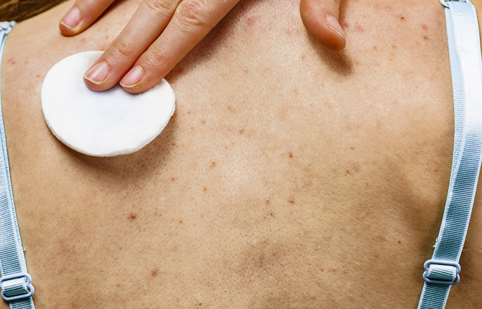 Woman using hydrogen peroxide for back acne