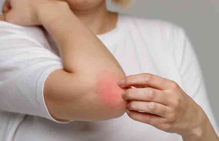Stearic acid helps soothe atopic dermatitis