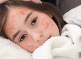 खसरा रोग के कारण, लक्षण और इलाज - Measles Symptoms and ...