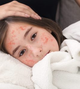 Measles Symptoms and Treatment in Hindi