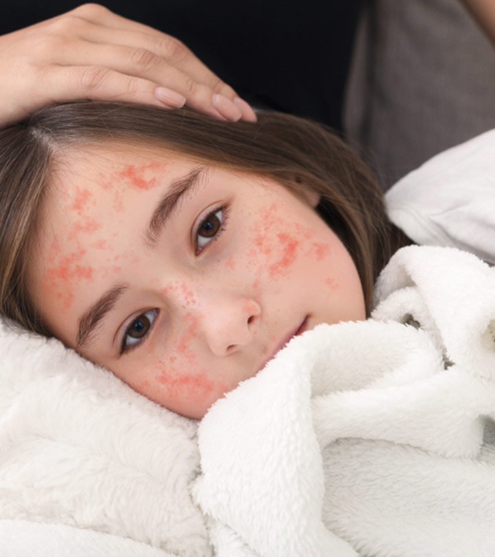खसरा रोग के कारण, लक्षण और इलाज - Measles Symptoms and ...