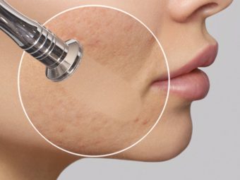 Microdermabrasion For Acne Scars Everything You Need To Know
