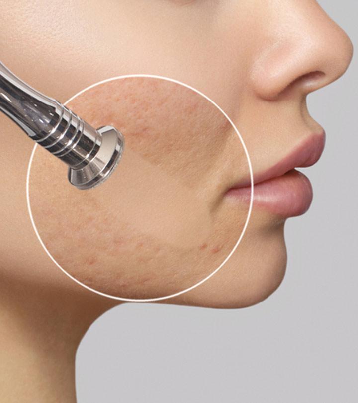 Microdermoabrasão para cicatrizes de acne: tudo o que você precisa saber