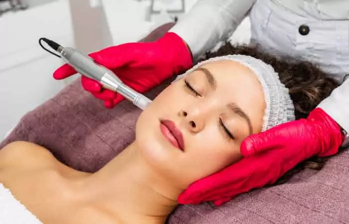 Microneedling