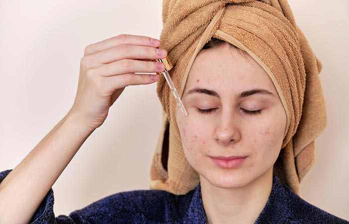 There are natural remedies like certain oils that might help soothe acne breakouts