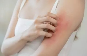 Woman with an allergic reaction on arm due to hydrogen peroxide