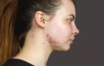 Signs and symptoms of nodular acne