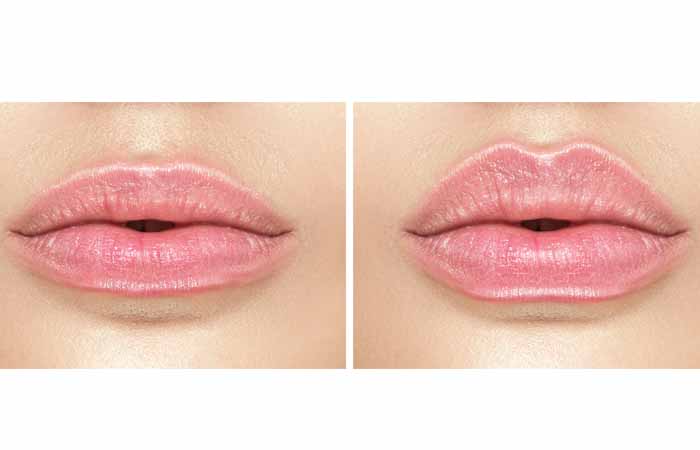 Lip injections vs lip flips