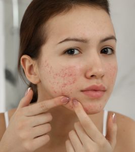 Vitamin D For Acne: Benefits, How To Use,...