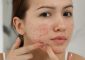 Vitamin D For Acne: Benefits, How To Use,...