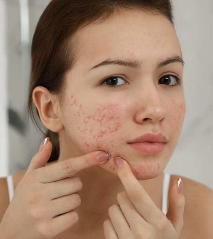 Vitamin D For Acne Benefits How To Use And Side Effects