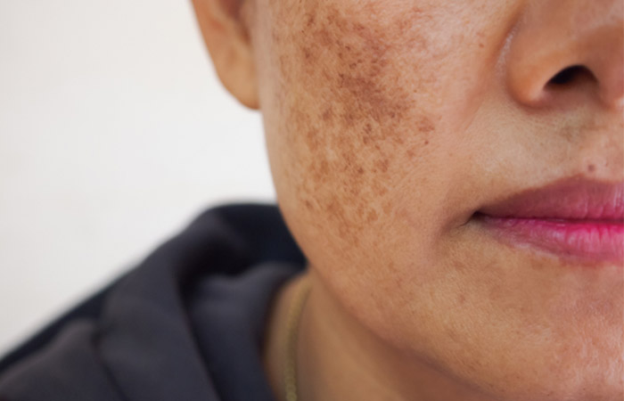 People with melasma should avoid products with octinoxate