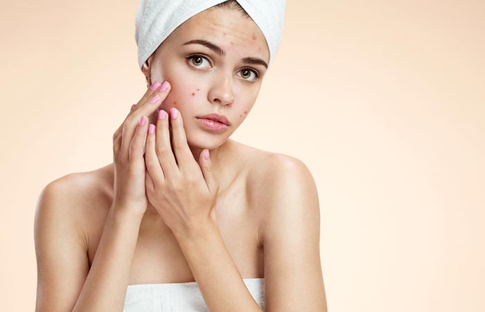 There are other treatment options you should consider to manage acne breakouts