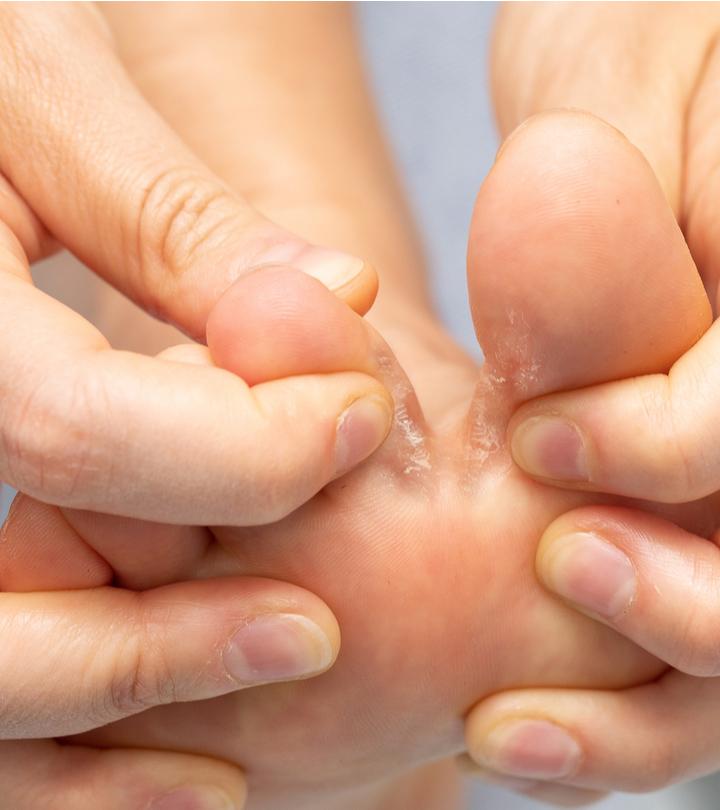 एथलीट फुट के कारण, लक्षण और इलाज – Athlete’s Foot Causes and Symptoms in Hindi